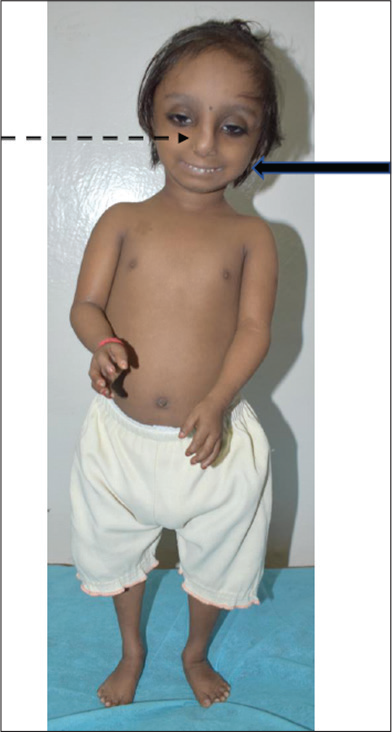 Primordial Dwarfism Mopd Type 1