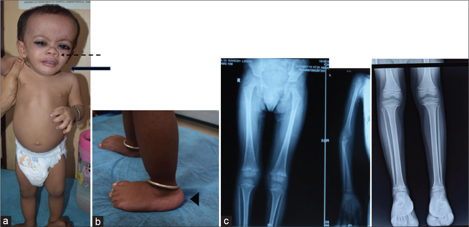 microcephalic osteodysplastic primordial dwarfism type ii