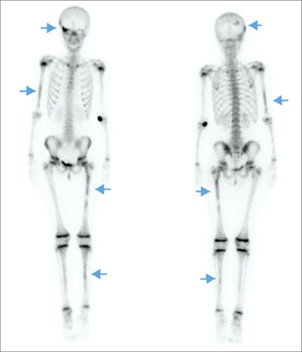 A 10-year-old girl with McCune–Albright syndrome without bone pain nor skeletal anomaly. Bone scintigraphy showing fibrodysplasic lesions (arrows) in the right posterolateral occiput and the upper part of the right orbit in the frontozygomatic bones, as well as in the distal two-thirds of the right humerus, the proximal two-thirds of left femur and a few foci in shin bones.