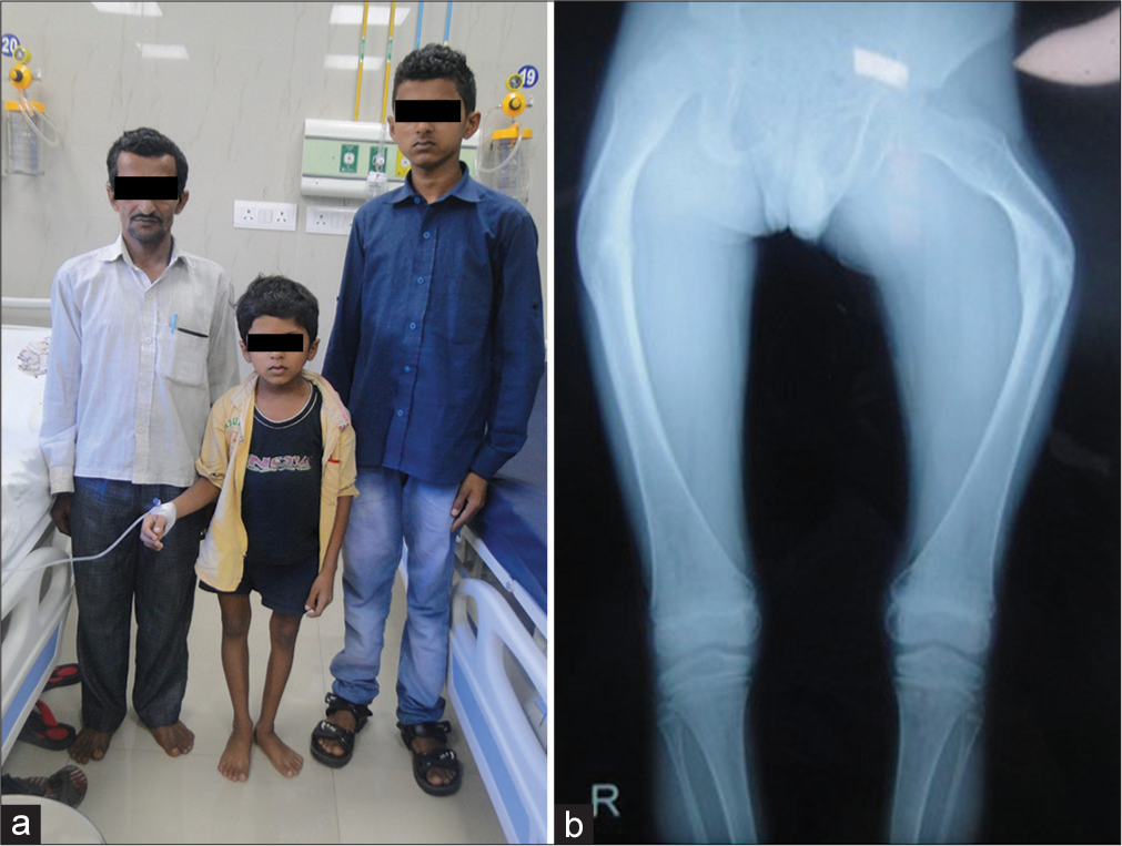 A family of osteogenesis imperfecta type IV due to pathogenic variant in COL1A2 gene (a) Affected father and his two sons (b) Bent femora.