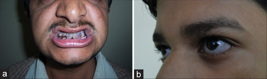 (a) Dentinogenous imperfecta (b) Bluish sclera.