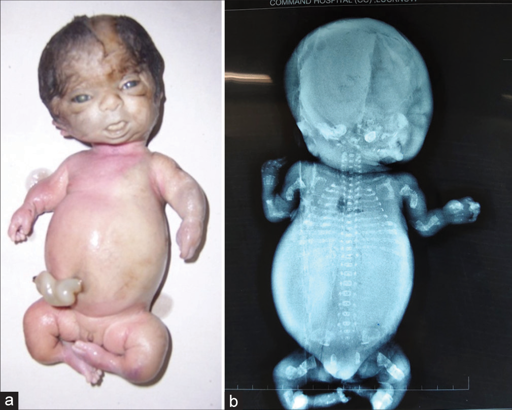(a and b) Lethal variety of osteogenesis imperfecta – Type II (a) The fetus showing short and bent limbs, short and narrow thorax (b) Radiograph showing short, bent, crumpled bones (inset), short thorax, beaded ribs and lack of mineralization of skull bones.