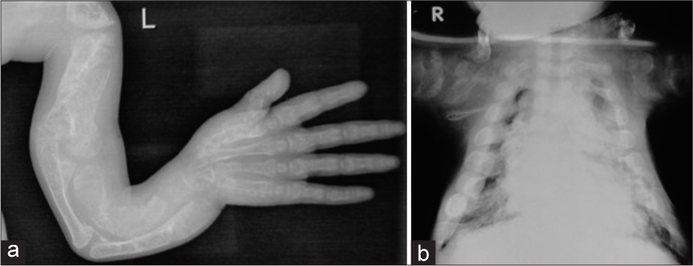 Radiographs of a child with osteogenesis imperfecta – Type III. (a) Note the deformed bones of the upper limb (b) Narrow thorax.