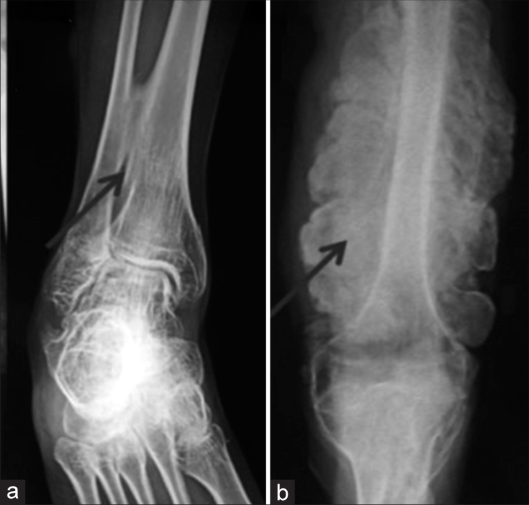 Radiographs of osteogenesis imperfecta – Type V showing (a) Ossified interosseous membrane (b) Hypertrophied callus.