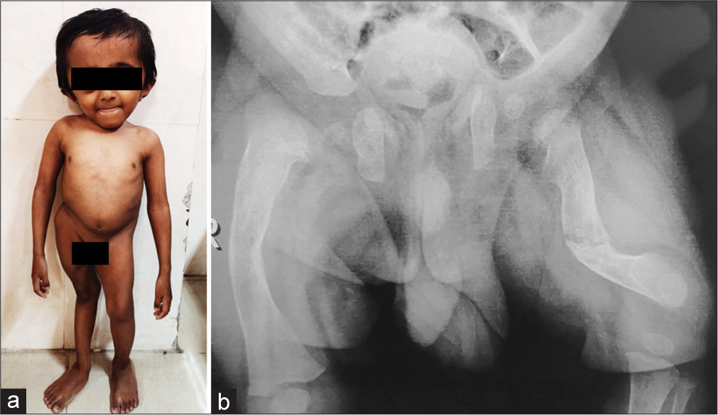 (a) Eight-year-old boy with osteogenesis imperfecta, type X with causative variant in SERPINH1 gene. (b) His radiograph of pelvis and femora.