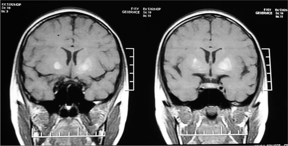 Coronal T1-weighted magnetic resonance imaging of that child, showing the diffuse high intensity of the bilateral putamen and globus pallidus, which was more intense on the left than the right side.