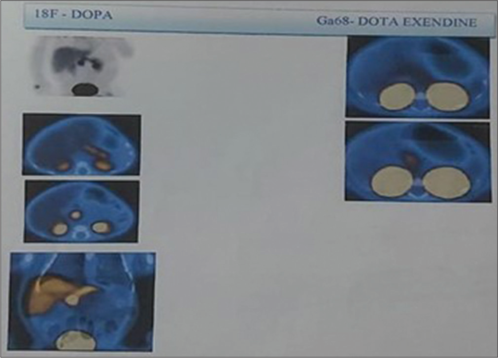 18F-DOPA positron emission tomography – Diffuse uptake in the pancreas with SUV 20.3. No obvious focal lesion in the pancreas. Gallium-68 Dota Extendin-4 scan – Diffuse uptake seen in the pancreas with SUV 3.7. 18F-DOPA: 18 Fluoro-dihydroxyphenylalanine, SUV: Standardized uptake value.