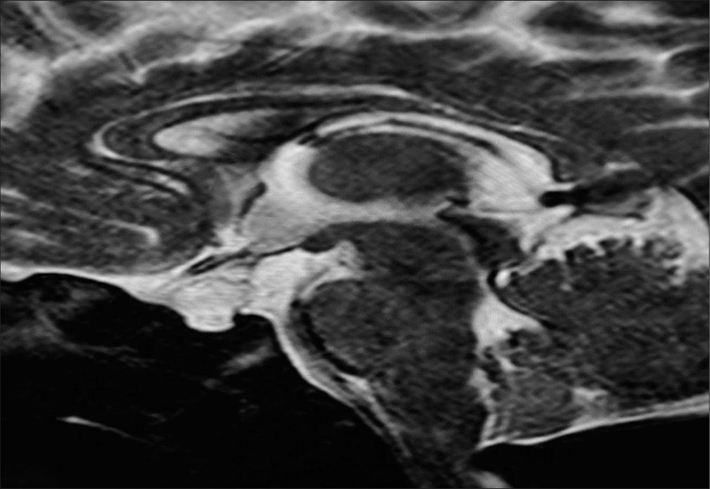 Cystic lesion within the sellar and suprasellar region significantly compressing the pituitary gland.