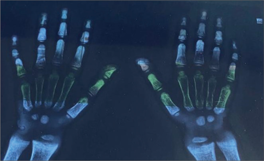 X-ray of the hand and wrist showing widening and fraying of the metaphyseal plate, coarse trabeculations, and thick cortices, which are prominent in X-linked hypophosphatemic rickets.