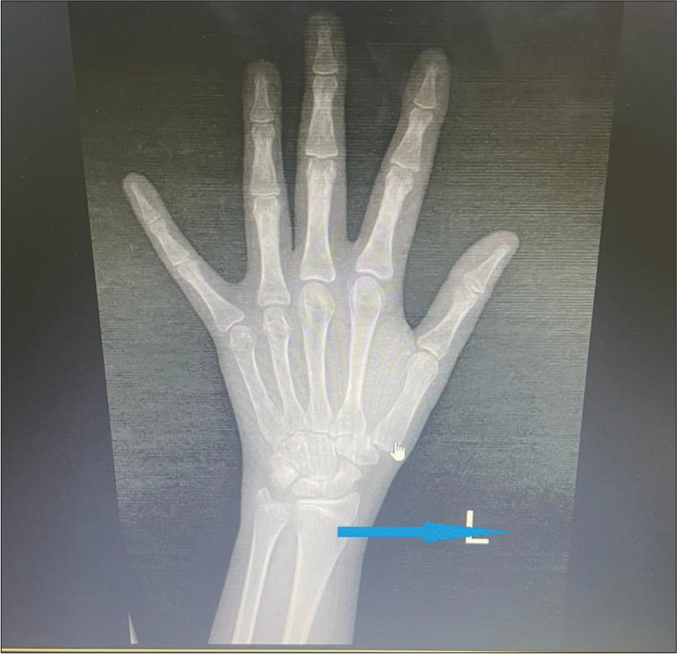 X-ray left wrist and hand revealed epiphyseal fusion (Blue arrow).