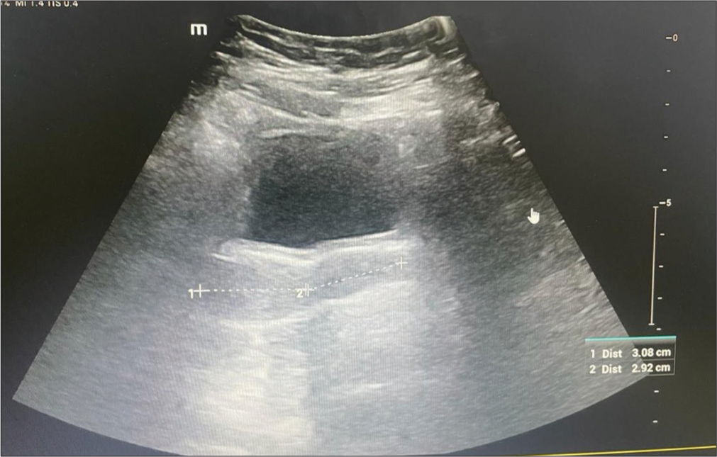 Ultrasonography showed an anteverted uterus measuring 3.1 × 2.2 × 2.4 cm, uterine cervix ratio of 1:1, and bilateral ovarian volume of 1.7–2 cc.