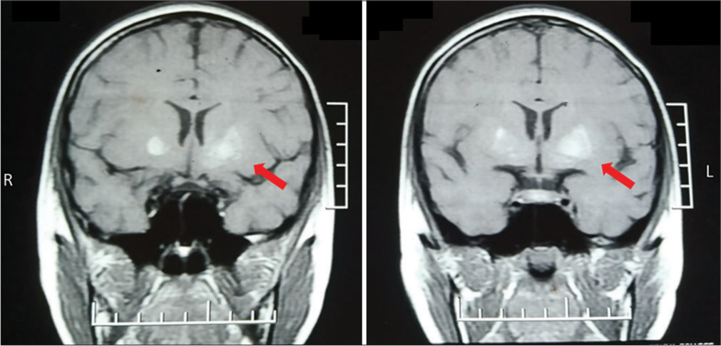 Coronal T1-weighted magnetic resonance imaging of that child, showing the diffuse high intensity of the bilateral putamen and globus pallidus which was more intense on left than on the right. Red arrows showing left putamen.