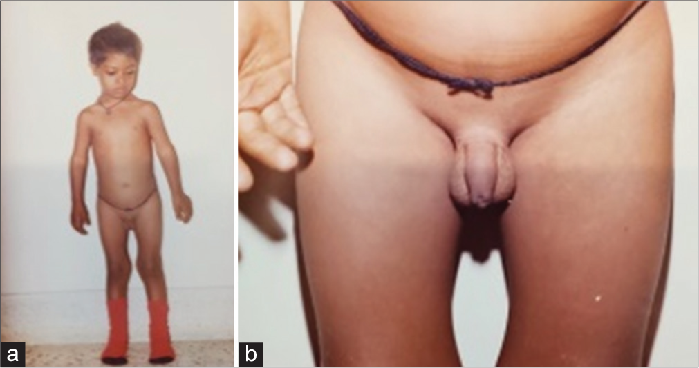 8-year-old boy with Down syndrome with primary hypothyroidism - post-treatment: (a) Frontal view, (b) Testes.