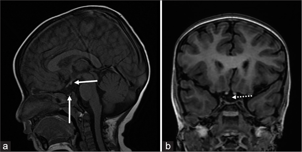 (a) A 2.3-year-old male with pituitary stalk interruption syndrome presented with hyponatremic seizures. T1 fast spin echo sagittal view of magnetic resonance imaging (MRI) brain shows small anterior pituitary (vertical white arrow) and ectopic posterior pituitary (horizontal white arrow) and (b) 3D-spoiled gradient echo of coronal view of MRI brain shows absent pituitary stalk (white dotted arrow).