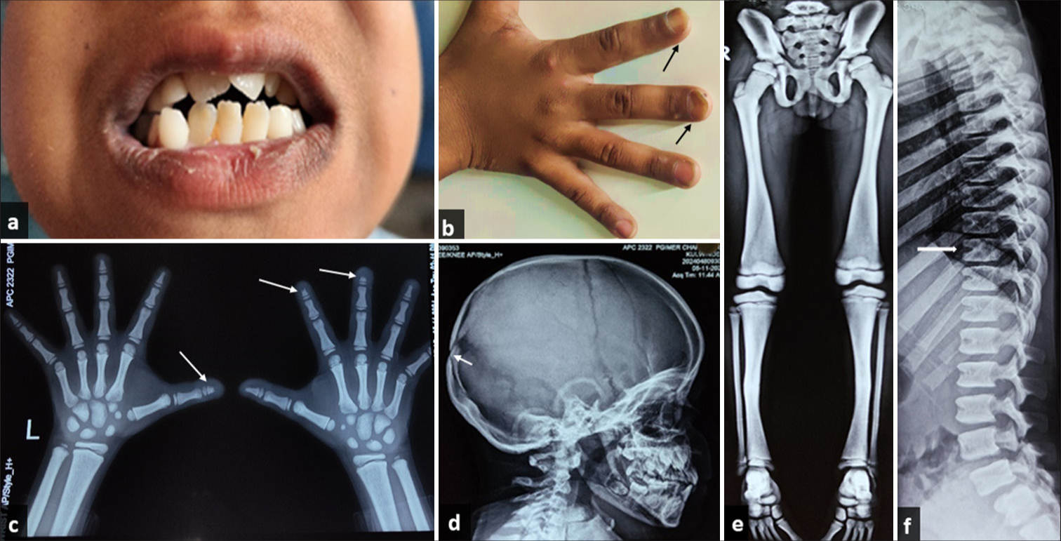 A 10-year-old boy with pycnodysostosis. (a) Dental crowding, (b) spoon-shaped nails (black arrows), (c) acro-osteolysis (white arrows), (d) open posterior fontanelle (white arrow), (e) osteosclerosis, and (f) notching of vertebrae (white arrow).