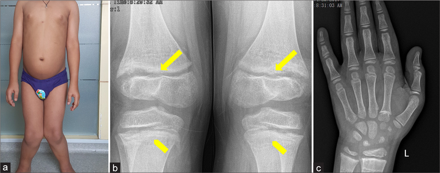 (a) Severe genu valgum, along with metaphyseal flaring (yellow block arrows) and metaphyseal lucencies (yellow chevron arrows) in the (b) knee and (c) hand radiograph.